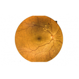 tratamento de retinopatia diabética com edema macular Chácara Santo Antônio