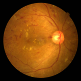 tratamento de retinopatia diabética fisiopatologia Congonhas