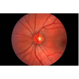 tratamento de retinopatia diabética fotocoagulação a laser Santa Cecília