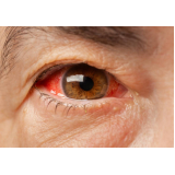 tratamento de retinopatia diabética fundo de olho Santa Cruz