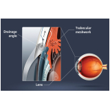 tratamento para glaucoma secundário Luz