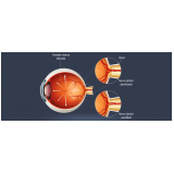 valor de glaucoma de ângulo aberto Luz