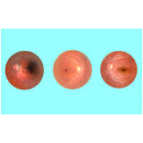 valor de retinopatia diabética cirurgia Artur Alvim