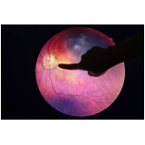valor de retinopatia diabética fisiopatologia Água Funda