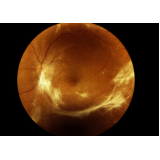 valor de retinopatia diabética proliferativa Brás