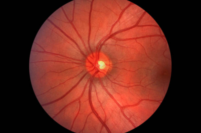 Tratamento de Retinopatia Diabética Fotocoagulação a Laser Chácara Inglesa - Retinopatia Diabética Fundo de Olho