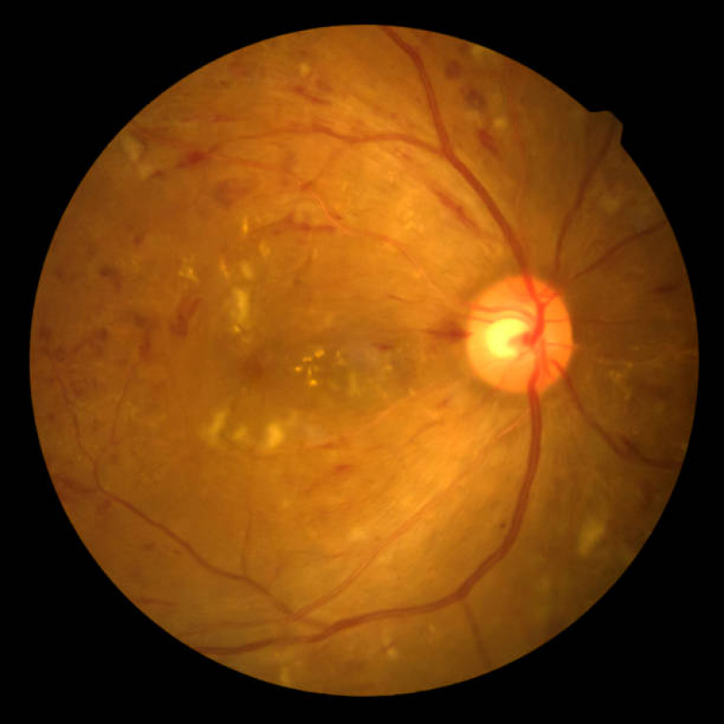 Tratamento de Retinopatia Diabética Tratamento a Laser Alto da Lapa - Retinopatia Diabética Fundo de Olho