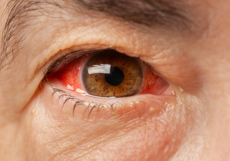 Tratamento de Retinopatia Proliferativa Diabética Perdizes - Retinopatia Diabética Fundo de Olho
