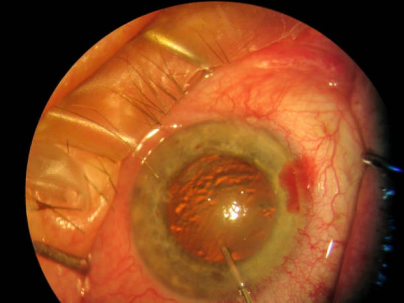 Valor de Cirurgia no Olho Catarata Jardim Marajoara - Cirurgia de Catarata no Olho