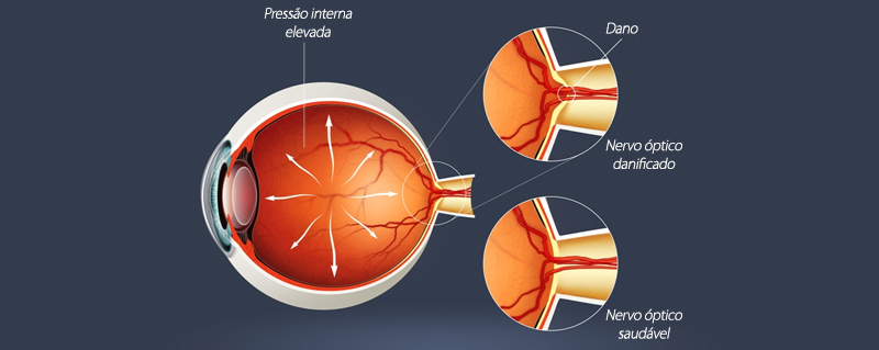Valor de Glaucoma de ângulo Aberto Glicério - Glaucoma de Corticoide