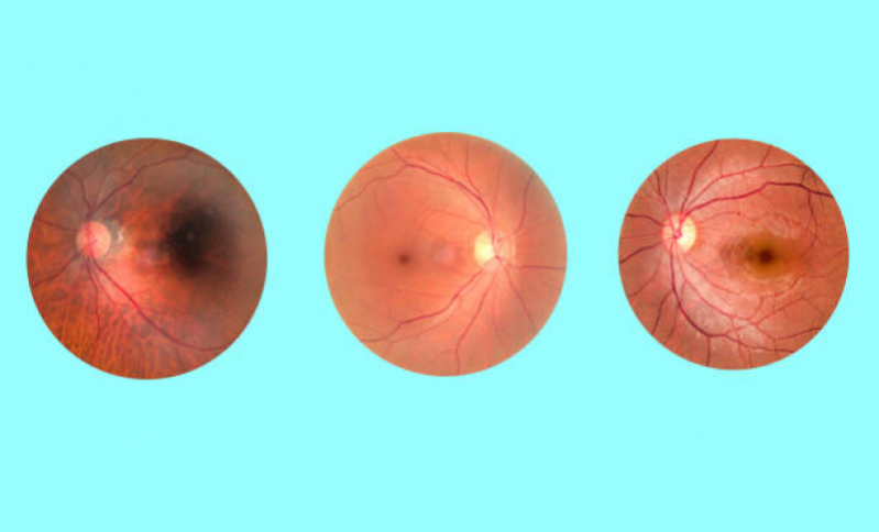 Valor de Retinopatia Diabética Tratamento com Injeção Intravítrea Zona Norte - Retinopatia Diabética Fundo de Olho